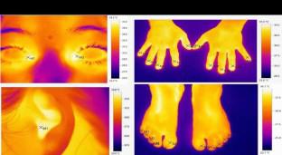 A Multicentric Case–Control Study for Diagnostic Utility of Non-contact Infrared Thermography (IRT) in Type 2 Diabetes