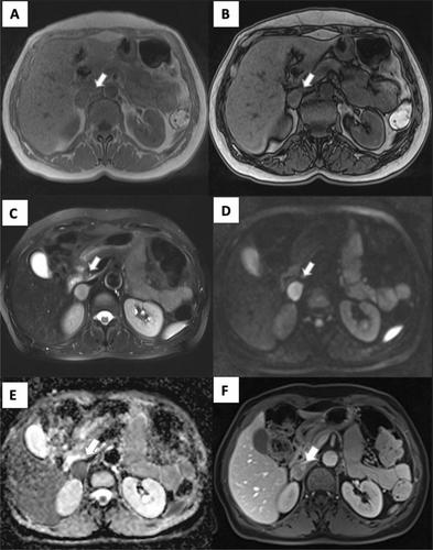 MR imaging characterization of pheochromocytoma: a comparison between typical and atypical tumor lesions