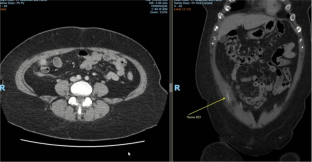 Novel Use of Laparoscopic Totally Extraperitoneal (TEP) Approach for Removal of Abdominal Wall Foreign Bodies