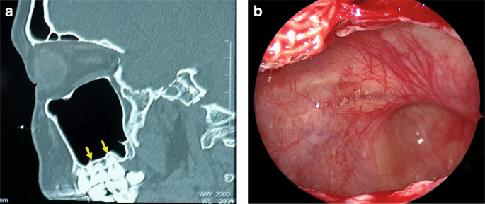 Expert consensus on odontogenic maxillary sinusitis multi-disciplinary treatment