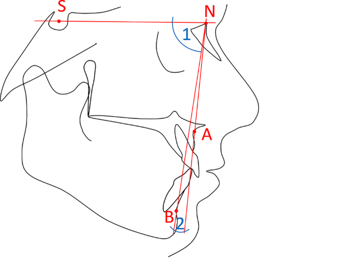 New insights into the genetics of mandibular retrognathism: novel candidate genes.