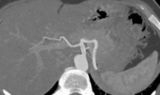 Comprehensive analysis of splenic artery variations using computed tomography angiography: development of the IPALGEA classification system