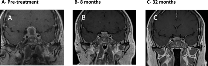 Pituitary hypophysitis in granulomatosis with polyangiitis (GPA): a case series.