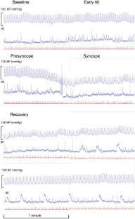 What lies beneath: cyclical giant bursts of SNA during vasovagal syncope