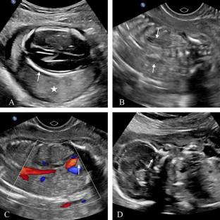 Fraser syndrome with limb reduction defect: a rare and unique anatomic variation