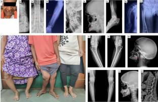 Inherited Fanconi renotubular syndromes: unveiling the intricacies of hypophosphatemic rickets/osteomalacia