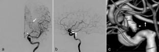 Replaced posterior cerebral artery