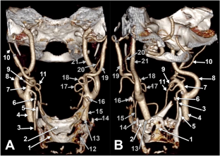 Lowered hyoid bone overlapping the thyroid cartilage in CT angiograms