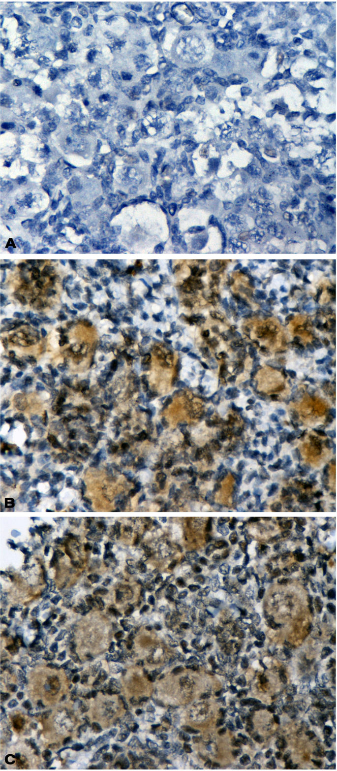 HNF1A gene mutations and premature ovarian failure (POF): evidence from a clinical paradigm combining MODY 3 and POF.