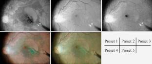 Color enhancement and achromatization to increase the visibility of indocyanine green-stained internal limiting membrane during digitally assisted vitreoretinal surgery.