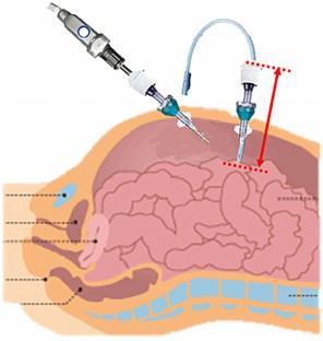 Impact of the combination of abdominal peripheral nerve block and neuromuscular blockade on the surgical space during robot-assisted laparoscopic surgery: a prospective randomized controlled study.