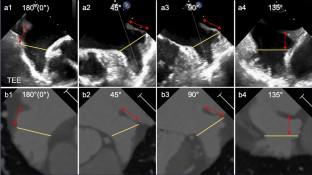 Comparison of left atrial appendage measurements between conventional transesophageal echocardiography and "Virtual TEE" reconstructed from computed tomography for pre-procedural planning of device closure.