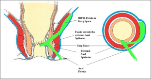 Recent Advances in the Understanding and Management of Anal Fistula from India