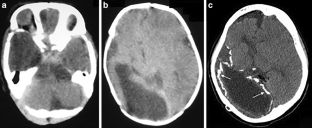 Haberland Syndrome (Encephalocraniocutaneous Lipomatosis) with Development of Diffuse Leptomeningeal Glioneural Tumor (DL-GNT) during Adolescence.