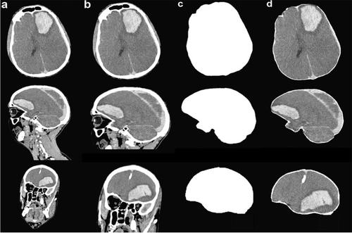 Automated detection of fatal cerebral haemorrhage in postmortem CT data.