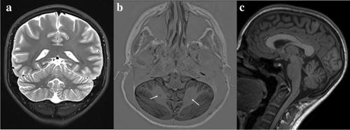 Cerebellar Heterotopia: Broadening the Neuroradiological Spectrum of KBG Syndrome.