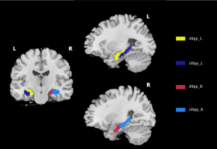 Functional connectivity changes of the hippocampal subregions in anti-N-methyl-D-aspartate receptor encephalitis.