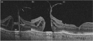 Analysis of the progression rate of idiopathic macular holes and the optimal cut-off for baseline minimum linear diameter and base diameter.