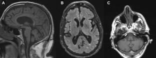 Syndrome of Irreversible Lithium-Effectuated Neurotoxicity (SILENT): A Preventable Cerebellar Disorder.