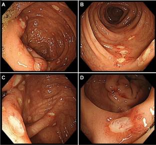 Intestinal Behcet’s Disease