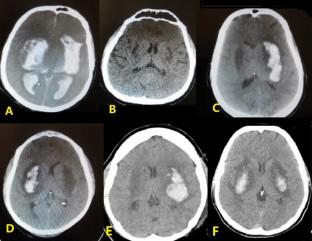 Intracerebral hemorrhage in methanol toxicity patients during COVID-19 pandemic: case report and review of literature.