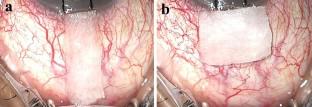 Two-year outcomes of anterior versus posterior scleral application of mitomycin C-soaked sponge in trabeculectomy.