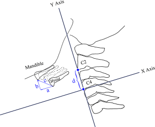 Dysphagia Pattern in Early to Moderate Parkinson's Disease Caused by Abnormal Pharyngeal Kinematic Function.