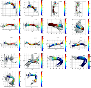 Brain white matter microstructural alterations in patients with systemic lupus erythematosus: an automated fiber quantification study.