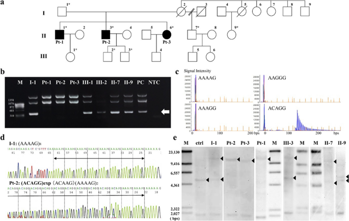 Comprehensive Analysis of a Japanese Pedigree with Biallelic ACAGG Expansions in RFC1 Manifesting Motor Neuronopathy with Painful Muscle Cramps.