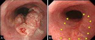 Remarkable response as a new indicator for endoscopic evaluation of local efficacy of non-surgical treatments for esophageal cancer.