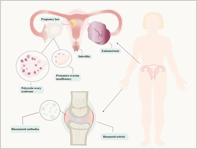 Reproductive Effect by Rheumatoid Arthritis and Related Autoantibodies.