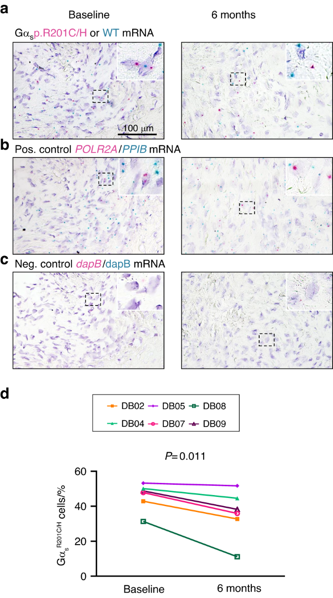 RANKL inhibition reduces lesional cellularity and Gαs variant expression and enables osteogenic maturation in fibrous dysplasia