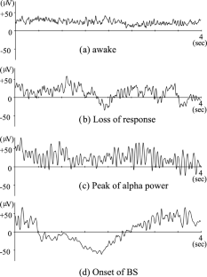 Effect of remifentanil on three effect-site concentrations of propofol and their relationship during electroencephalography at loss of response, at maximum alpha power, and at onset of burst suppression: a prospective randomized trial.