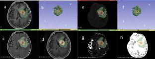 Image Omics Nomogram Based on Incoherent Motion Diffusion-Weighted Imaging in Voxels Predicts ATRX Gene Mutation Status of Brain Glioma Patients.