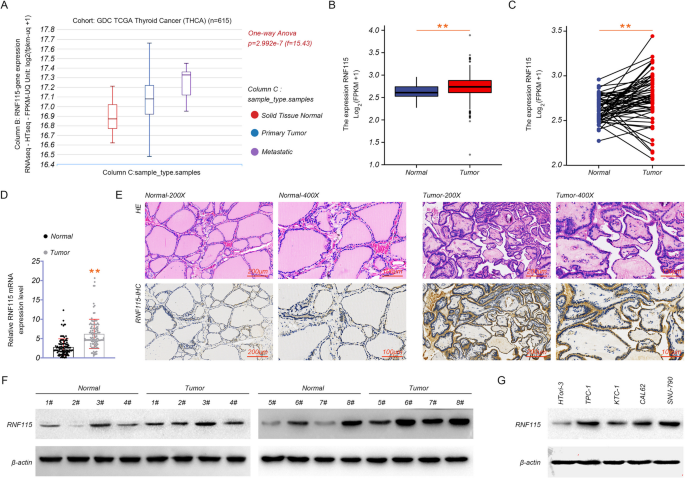 RNF115 aggravates tumor progression through regulation of CDK10 degradation in thyroid carcinoma.