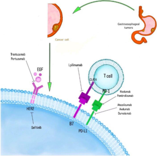 Who Should Receive Immunotherapy for Advanced Gastroesophageal Cancer?