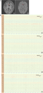 Heterozygous CAPZA2 mutations cause global developmental delay, hypotonia with epilepsy: a case report and the literature review