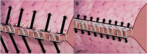 Safety and efficacy of new staple-line reinforcement in lung resection: a prospective study of 48 patients.