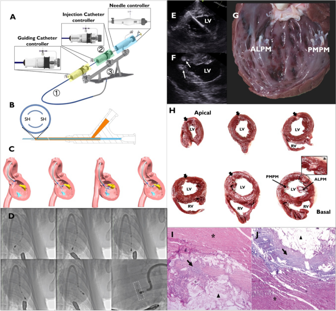 Percutaneous Alginate Hydrogel Endomyocardial Injection with a Novel Dedicated Catheter Delivery System: An Animal Feasibility Study.