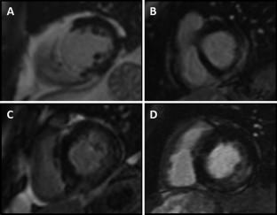 Late/delayed gadolinium enhancement in MRI after intravenous administration of extracellular gadolinium-based contrast agents: is it worth waiting?