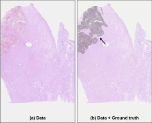 A Comparative Study of Performance Between Federated Learning and Centralized Learning Using Pathological Image of Endometrial Cancer.