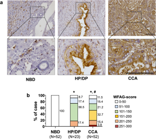 Role of Wisteria floribunda agglutinin binding glycans in carcinogenesis and metastasis of cholangiocarcinoma.