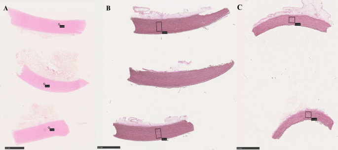 Impact of prolonged storage time on homograft ultrastructures: an attempt to find optimal guidelines for homograft processing.