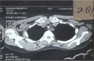 Anaesthetic Management of a Patient with Tracheal Mass: a Case Report