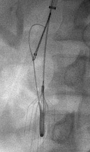 Inferior Vena Cava Filter Retrieval: Simple to Complex.