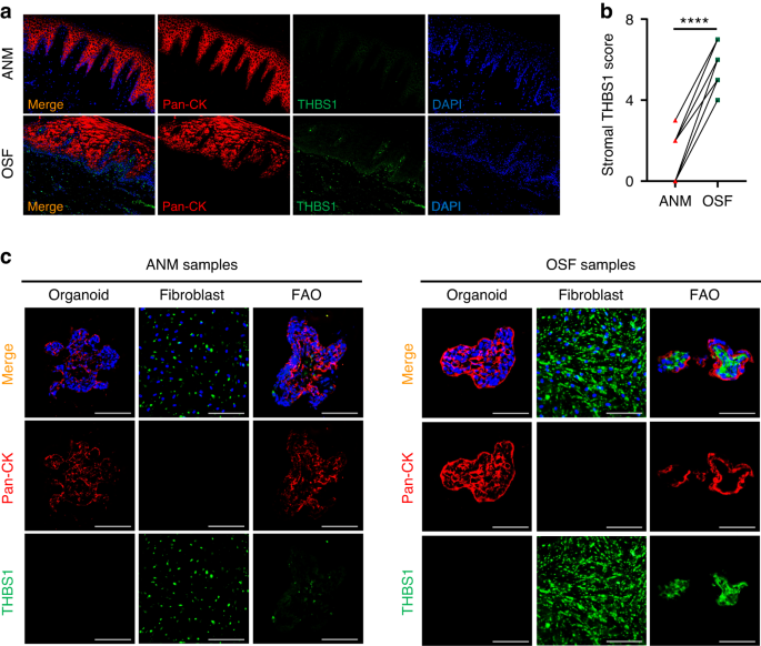 Stromal thrombospondin 1 suppresses angiogenesis in oral submucous fibrosis