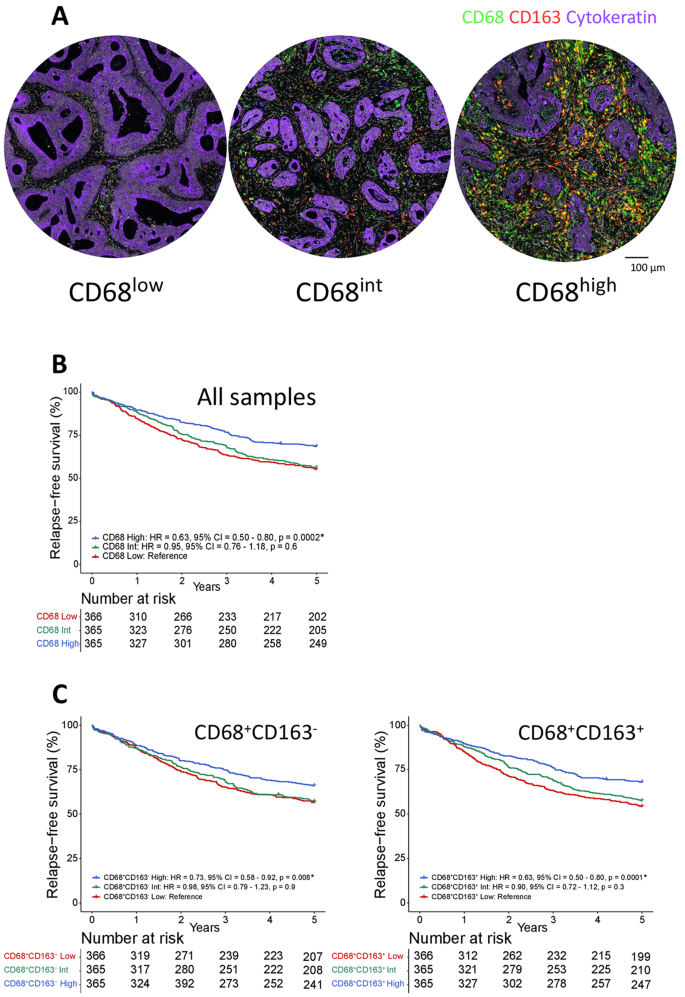 The prognostic effect of tumor-associated macrophages in stage I-III colorectal cancer depends on T cell infiltration