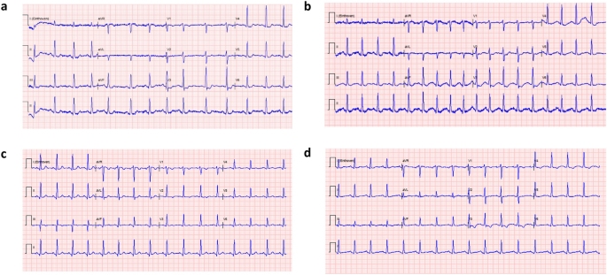 Cardiotoxicity After Synthetic Cathinone Use; Two Cases, A Case Series and Scoping Review.