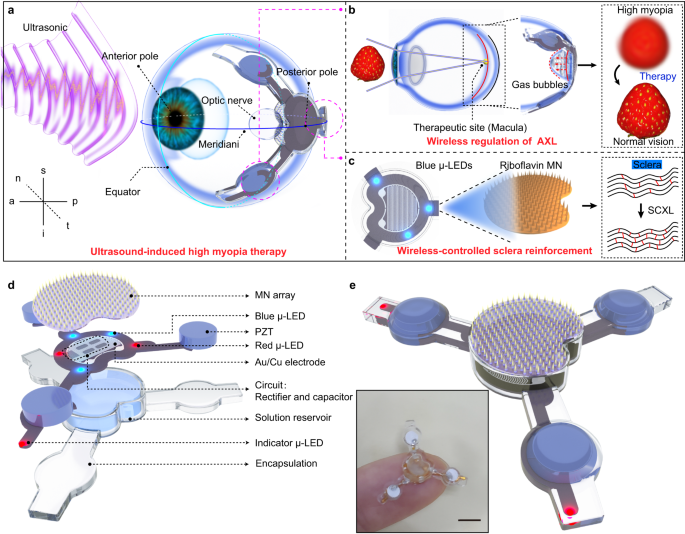 A wireless battery-free eye modulation patch for high myopia therapy.