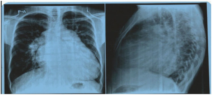 Severe Pulmonary Hypertension From Combined Ventricular Septal Defect and Rheumatic MIitral Valve Disease: A Case Report and Literature Review.